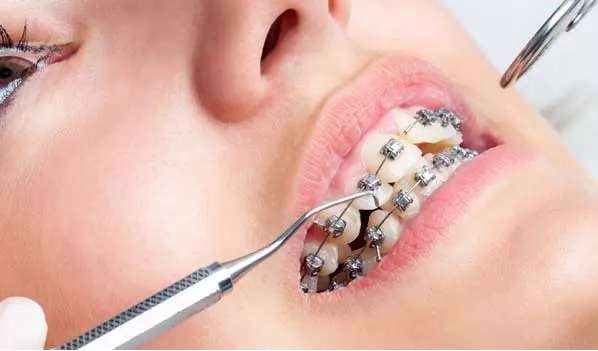 هزینه ارتودنسی و قیمت ارتودنسی دندان ۱۴۰۲ (پرداخت قسطی و بیمه) - دکتر قریشی