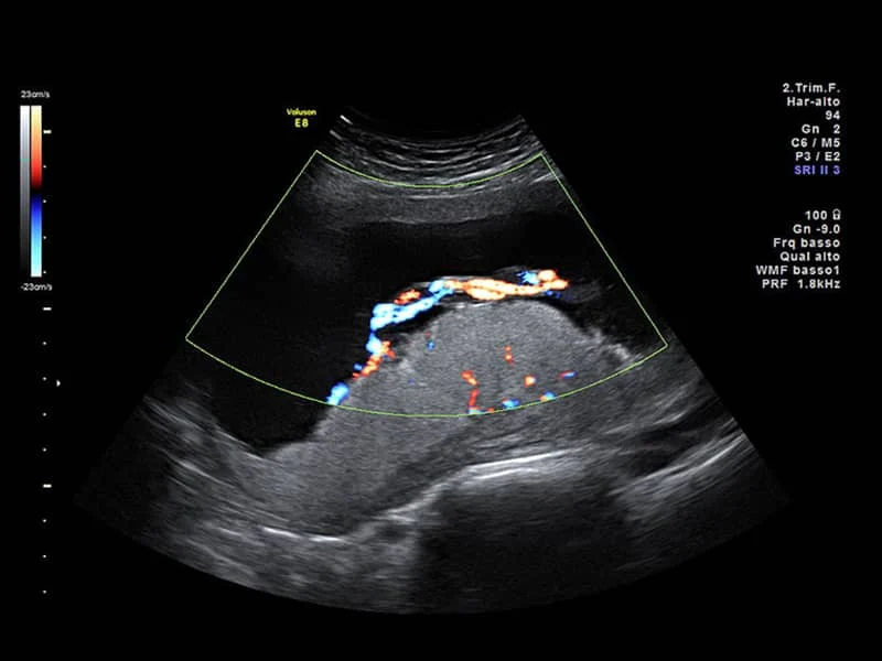 Normal fetal bpd size at 12 weeks