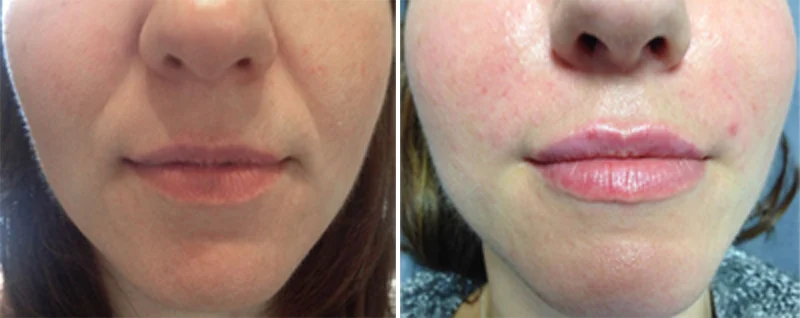 Actions after laugh line gel injection