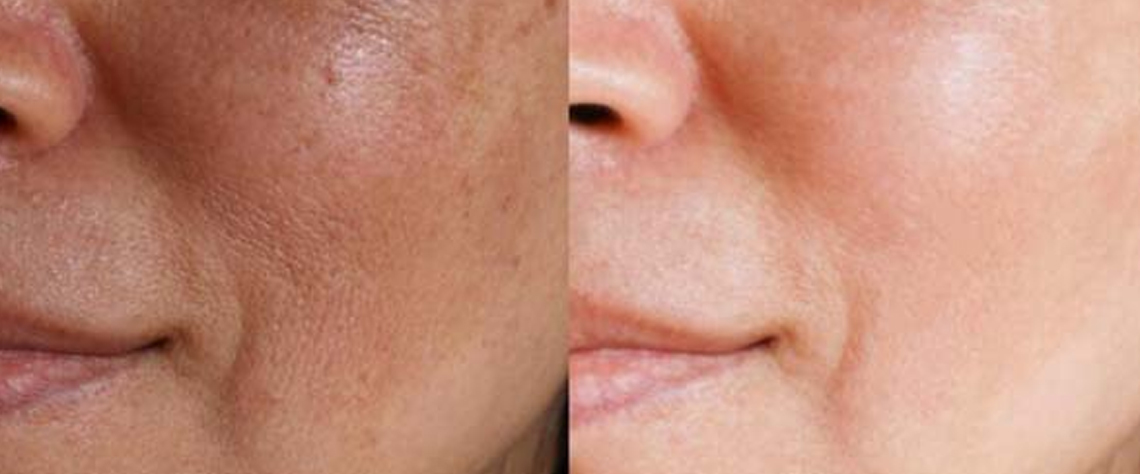 نحوه بازسازی پوست با سرم سیلکر