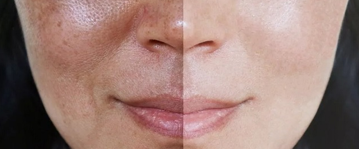 عوامل محیطی و سبک زندگی در تیرگی پوست