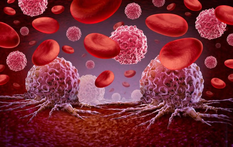 هوش مصنوعی CytoDiffusion انقلابی در تشخیص زودهنگام سرطان خون